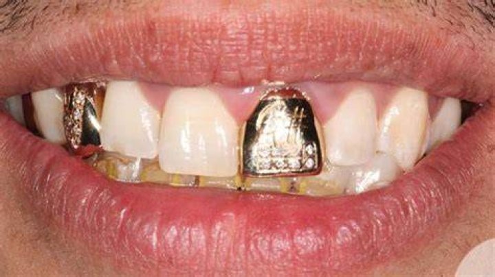 How did people get gold teeth?